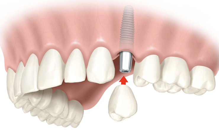 Implantologia clinica dental aranjuez