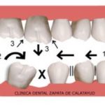 reponer nuestros dientes perdidos